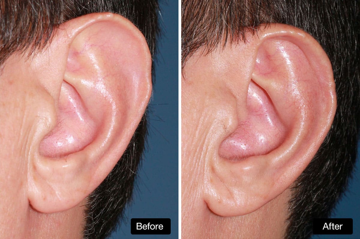Ear Reduction: 44 yo Male Before and After Ear Reduction Surgery - upper part of ear reduced in size [1A & B]