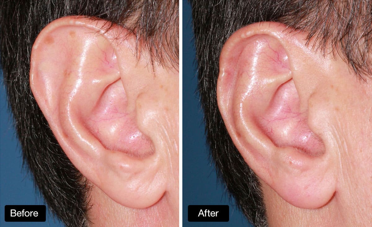 Ear Reduction: 44 yo Male Before and After Ear Reduction Surgery - upper part of ear reduced in size [1A & 2B]