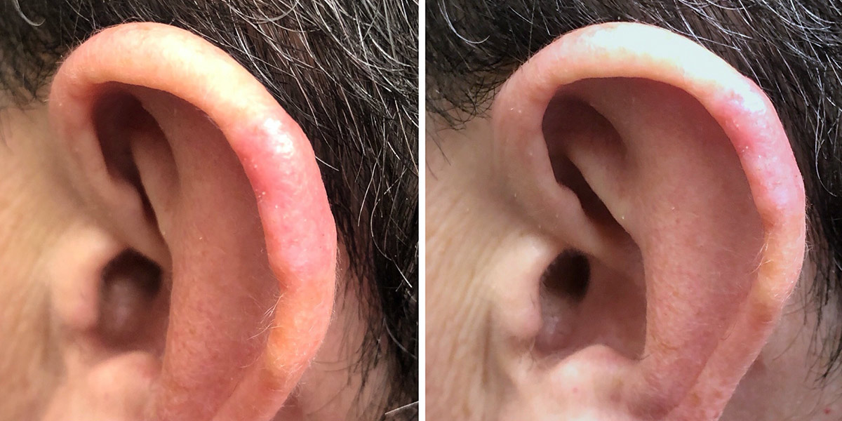 After: 3 weeks following surgery - Melanoma excised from the ear and treated with a skin graft taken from behind the ear.