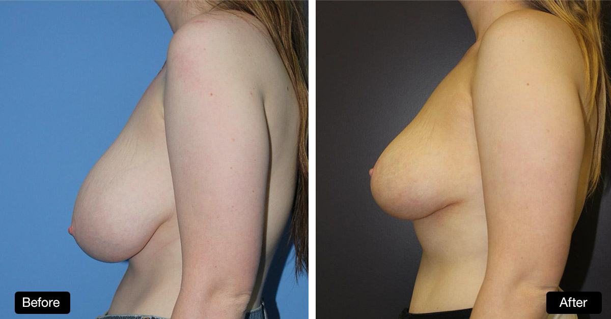 Breast Reduction / Mastopexy - 20 Year Old Patient Before & After (3)