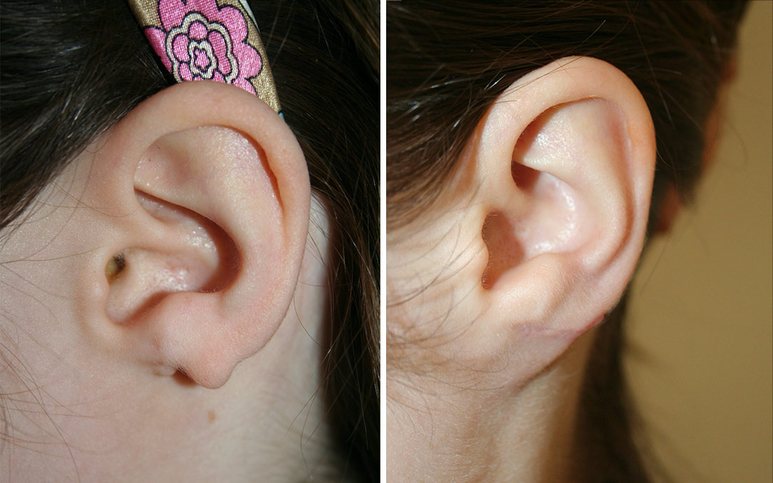 Before & After: Ear Reconstruction of congenital ear lobe defect - Dr Nicholas Lotz