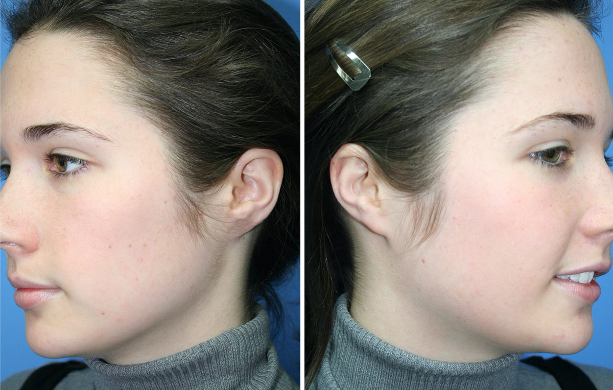 Final Result: Before & After: Ear Reconstruction of congenital ear lobe defect - Dr Nicholas Lotz