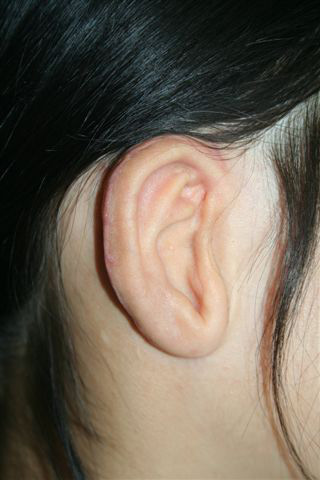1D - After elevation of ear (second stage of ear reconstruction for microtia)