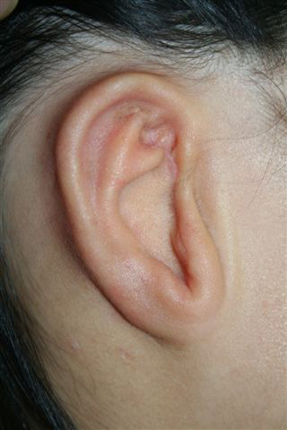 1C - After first stage of ear reconstruction for microtia