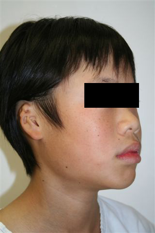 Pre-Operative: 13 year-old boy with isolated right microtia. A