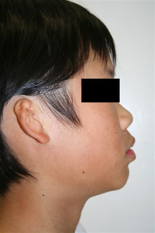 Pre-Operative: 13 year-old boy with isolated right microtia. B