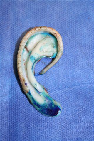 Ear framework sculpted from rib cartilage. C