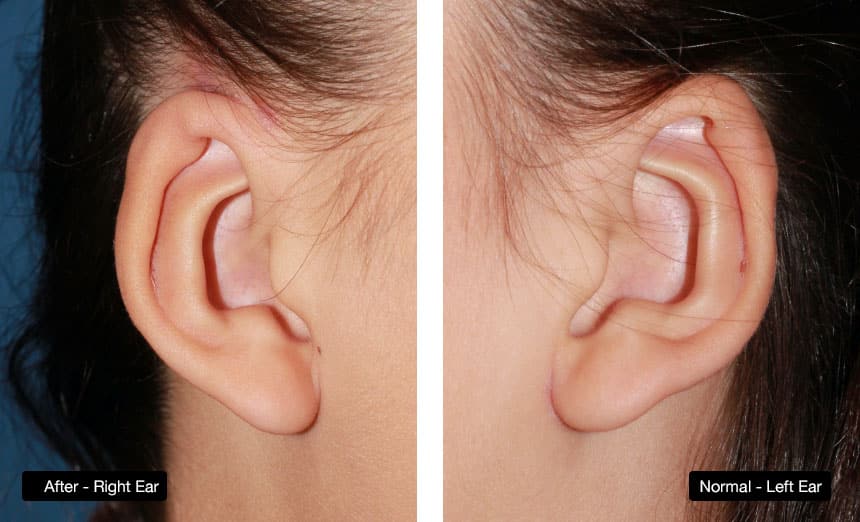 Ear Reconstruction surgery for Cryptotia: Right ear compared to normal left ear appearance after reconstructive surgery
