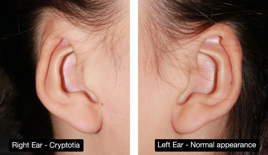 Minor ear deformity - cryptotia