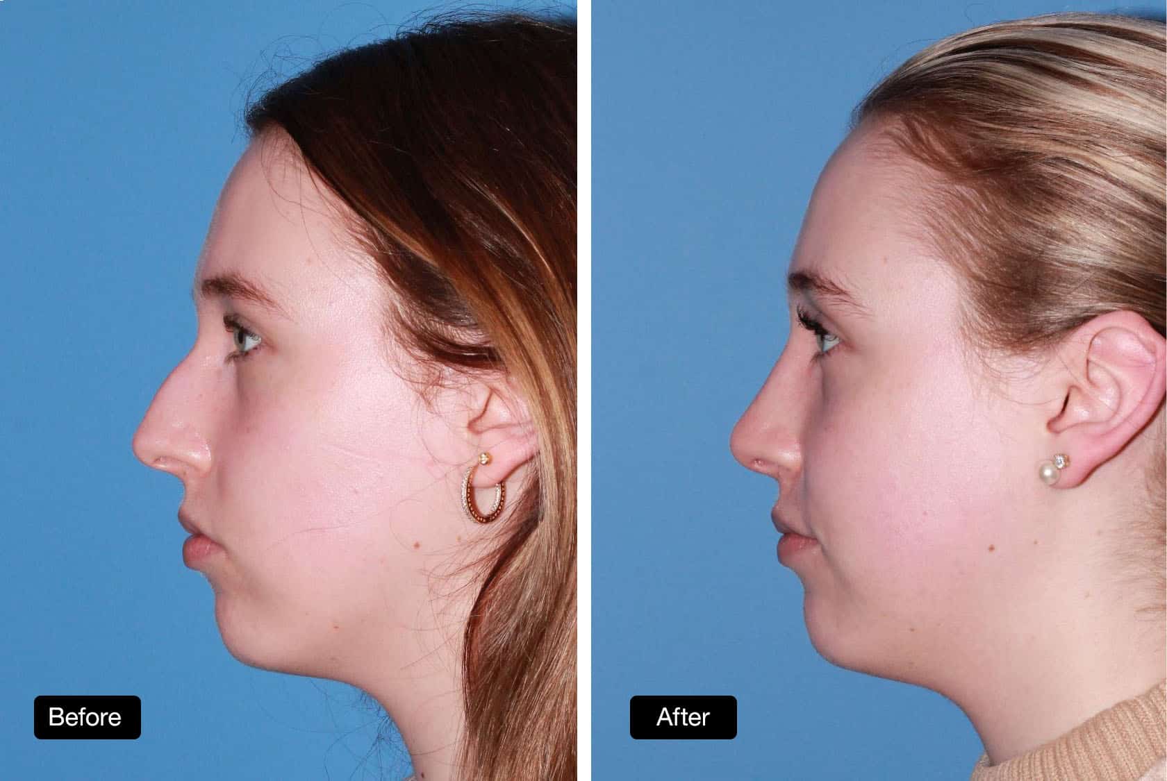 Rhinoplasty - Patient Before and After: 23 year old patient with dorsal reduction and tip refinement (1)