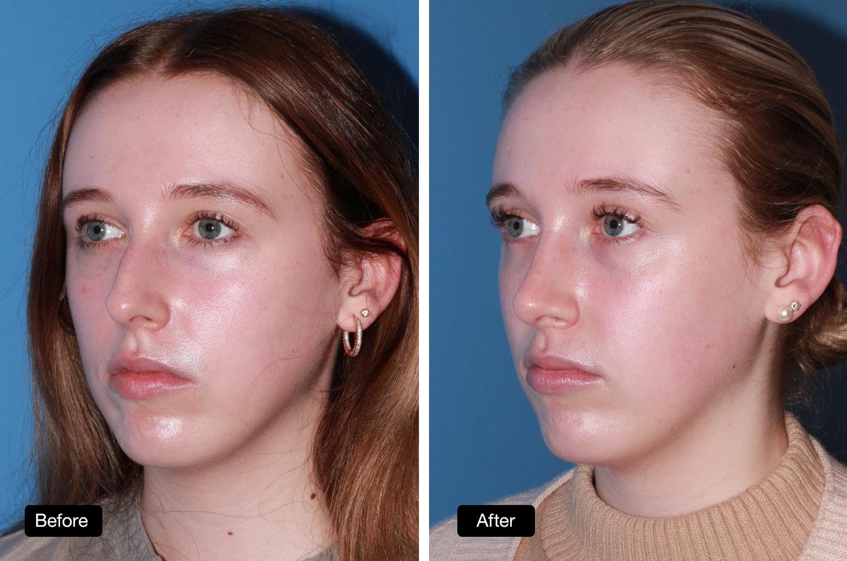 Rhinoplasty - Patient Before and After: 23 year old patient with dorsal reduction and tip refinement (2)