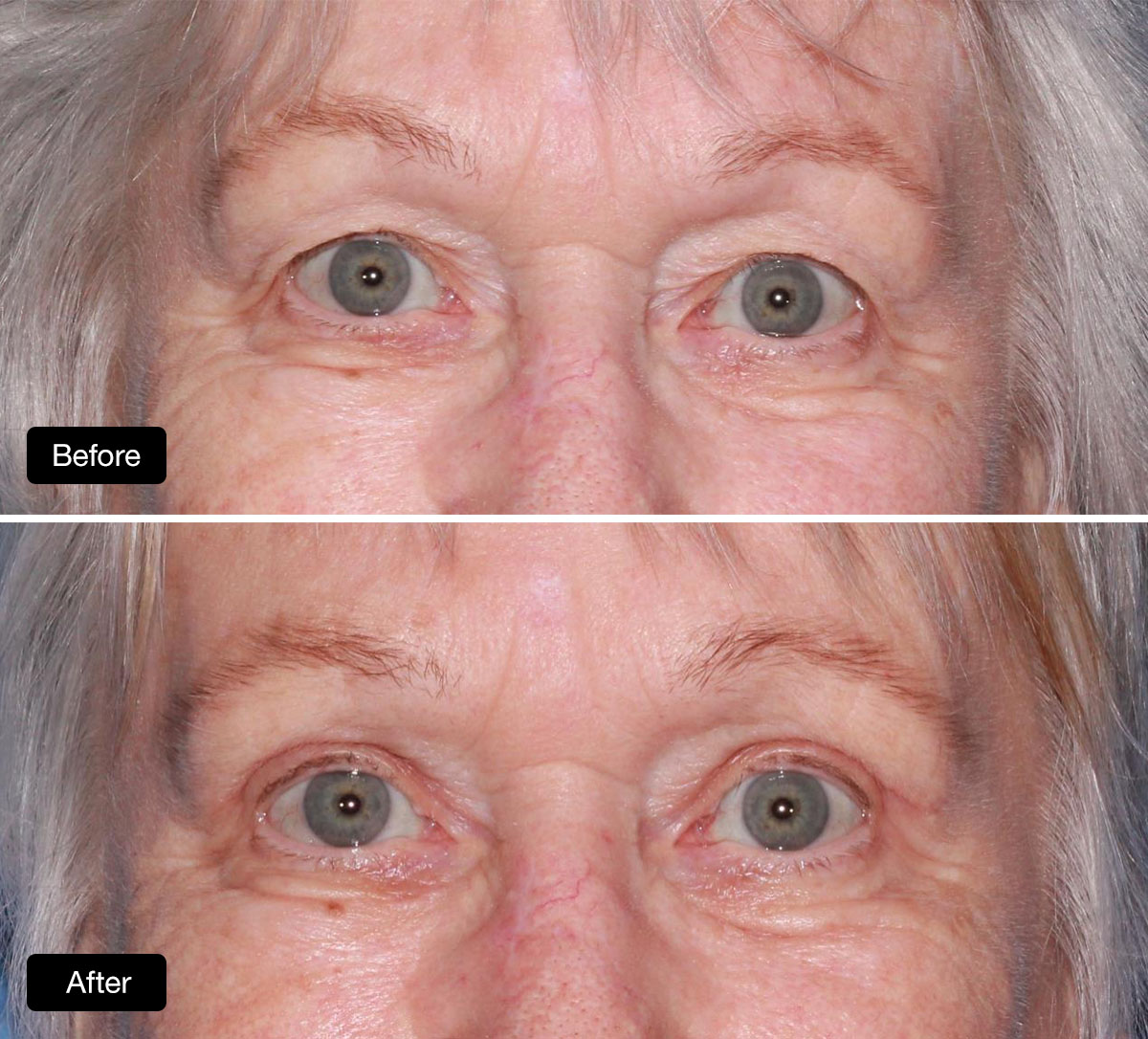Upper blepharoplasty 81 year old patient before surgery and 6 weeks post surgery