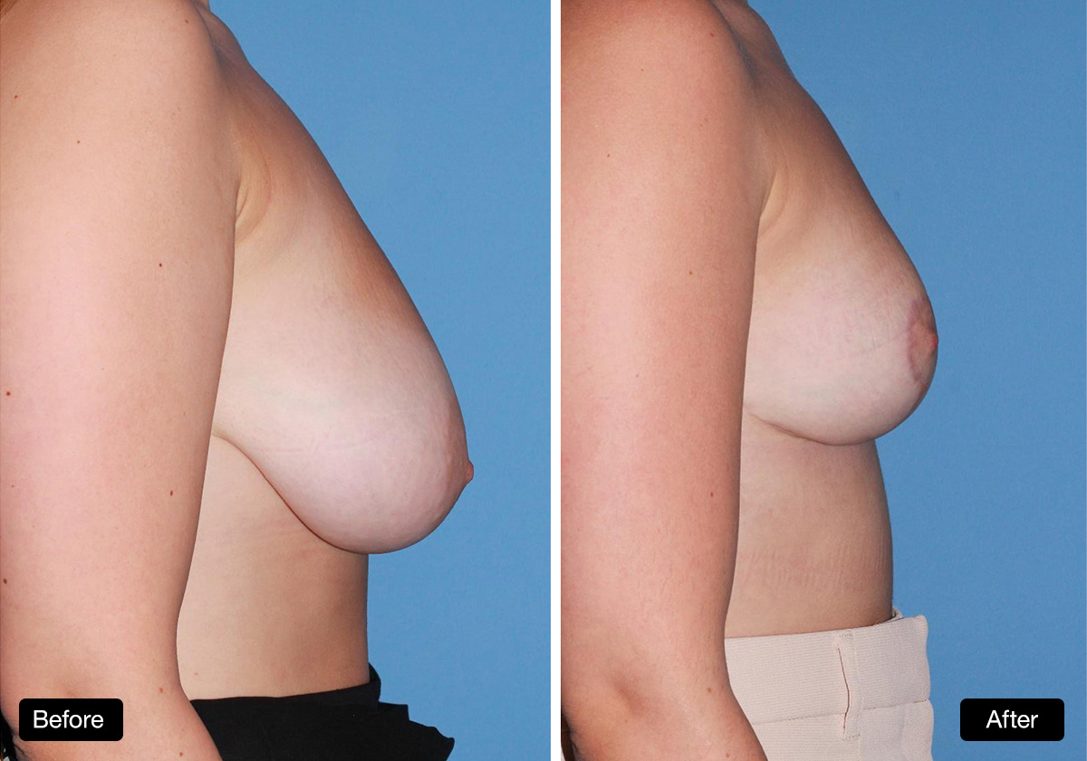 Breast reduction surgery and correction of breast asymmetry: 19yo patient before & after - 3a & 3b