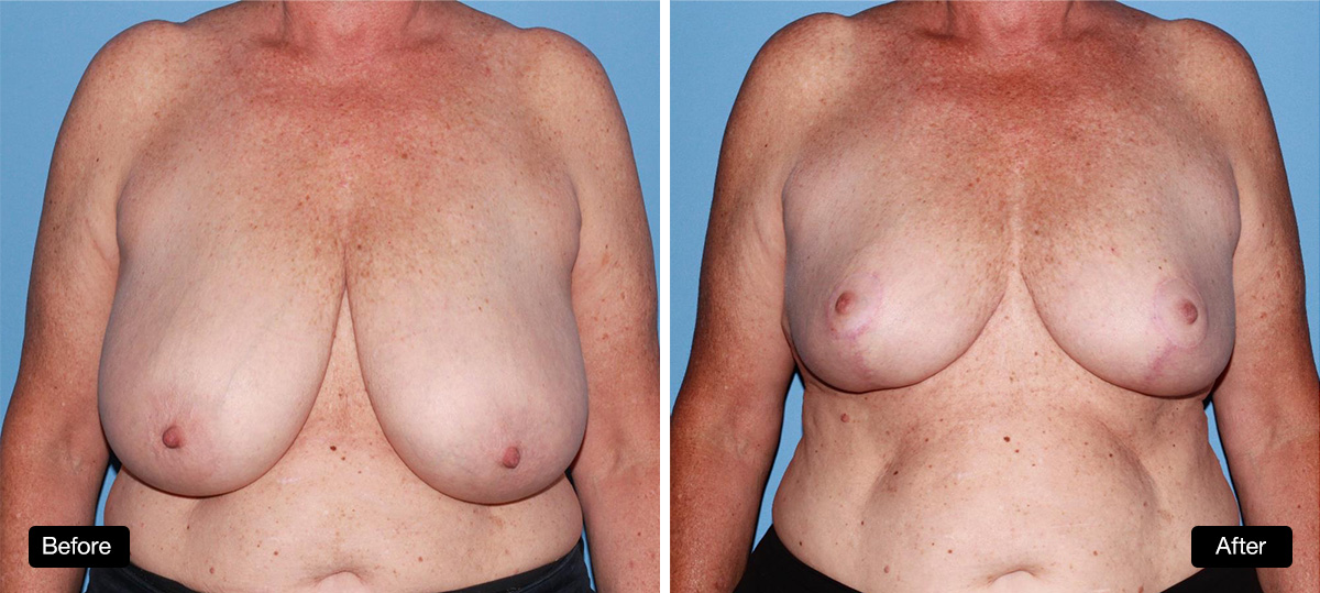Breast reduction surgery, 57 year old patient before and after taken 6 months post surgery - 1a & 1b