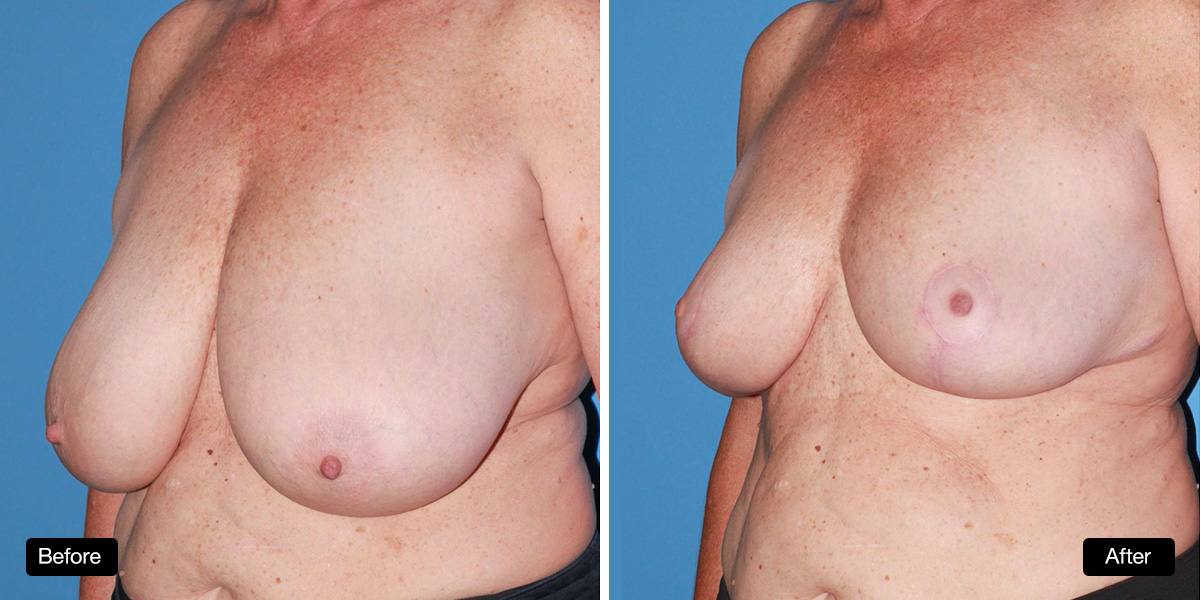 Breast reduction surgery, 57 year old patient before and after taken 6 months post surgery - 3a & 3b