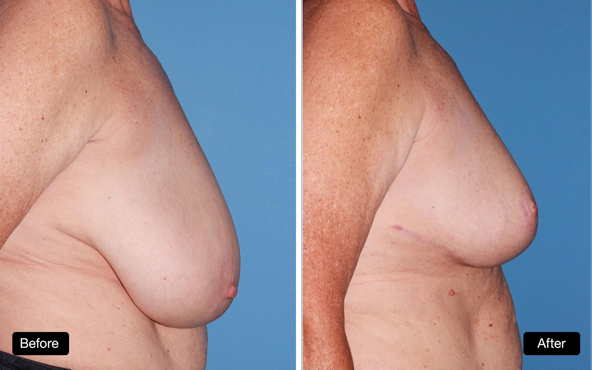 Breast reduction surgery, 57 year old patient before and after taken 6 months post surgery - 3a & 3b