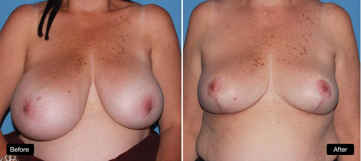 Breast reduction surgery - 48 year old with marked breast asymmetry, before and 5 months post surgery, 1a & 1b