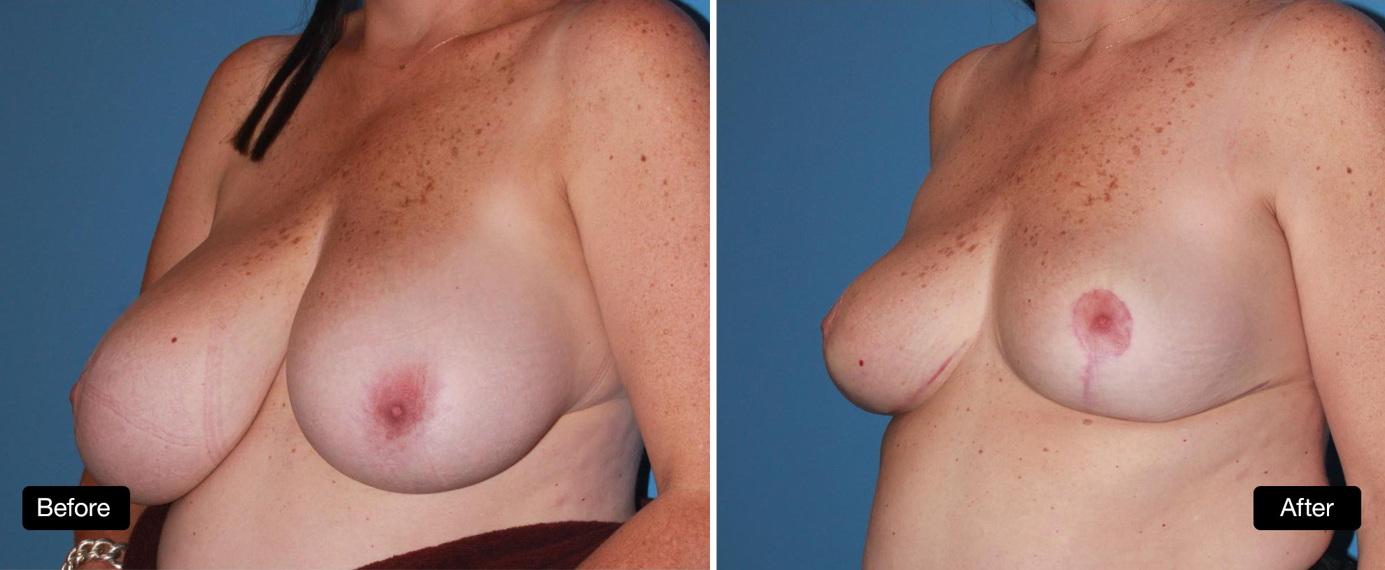 Breast reduction surgery - 48 year old with marked breast asymmetry, before and 5 months post surgery, 2a & 2b