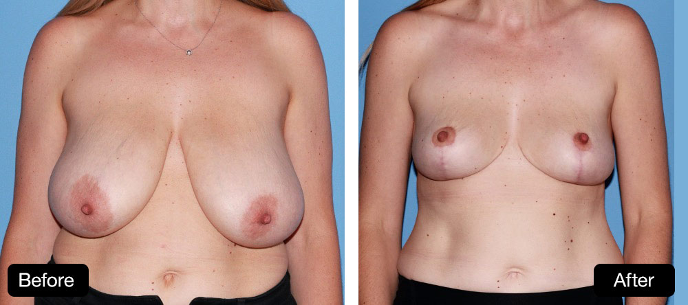 Breast reduction - 37 year old. Before and After: 400g from R side and 500g from left side