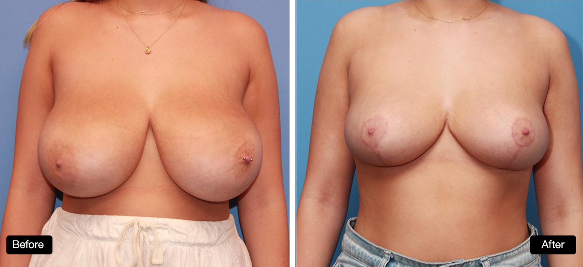 Breast reduction surgery, 21 year old patient before and after 4 months post op - 1a & 1b