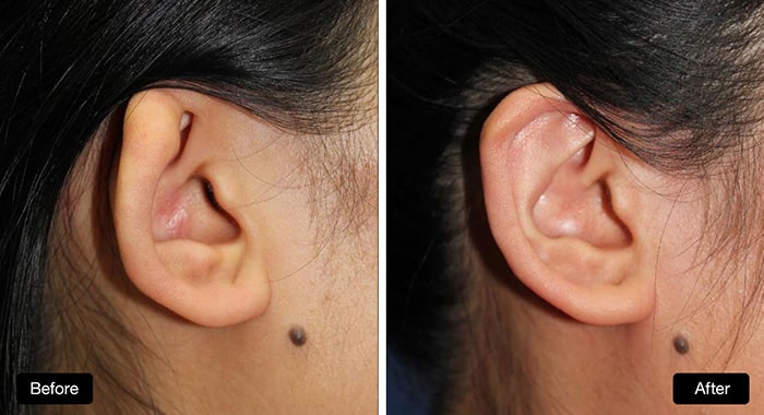 Ear Reconstruction - cartilage graft to repair small folded ear