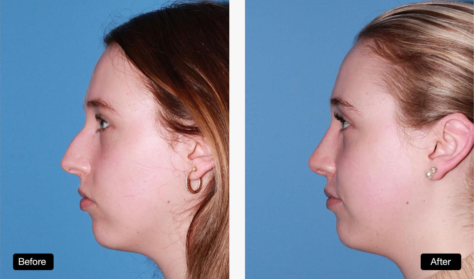 Rhinoplasty - Patient Before and After: 23 year old patient with dorsal reduction and tip refinement
