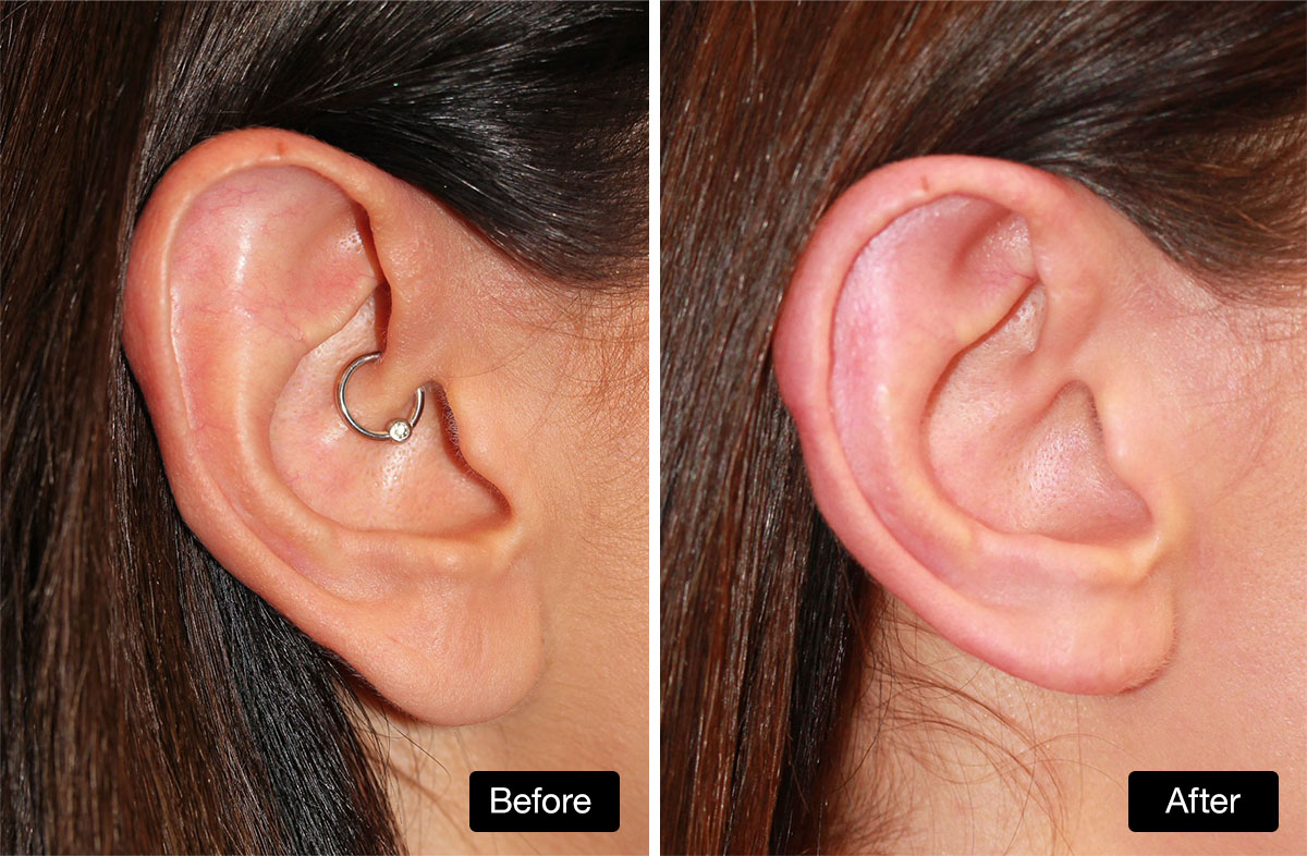 Ear Reduction: Before and After Surgery - reduction of both the lobule and upper part of the ear