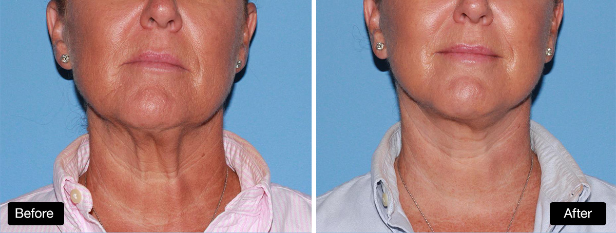 Lower face and neck lift with platysmaplasty: before and after #1