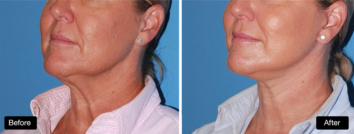 Lower face and neck lift with platysmaplasty: before and after #2