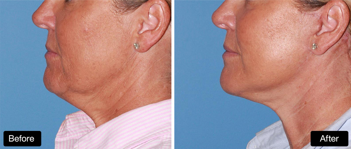 Lower face and neck lift with platysmaplasty: before and after #3